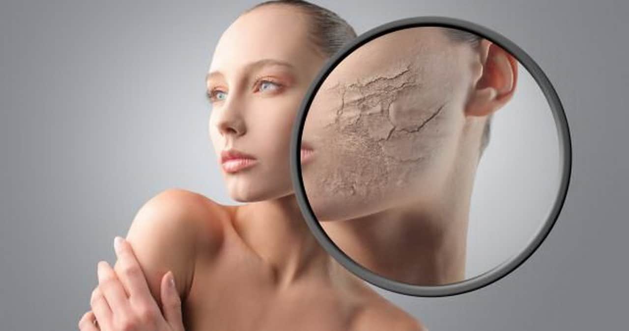 Akne und Demodex