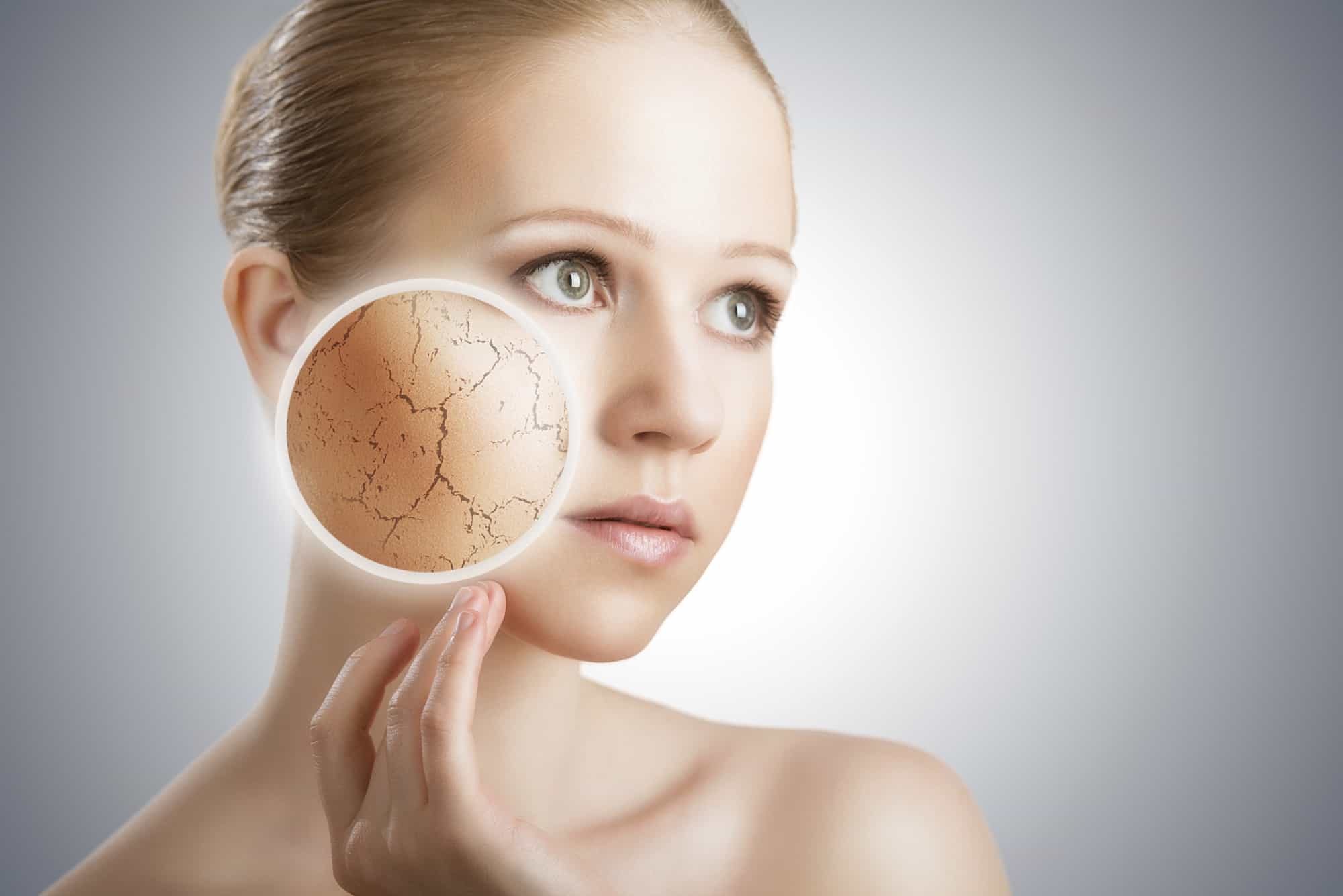 Rosacea - Hauttyp oder Krankheit?