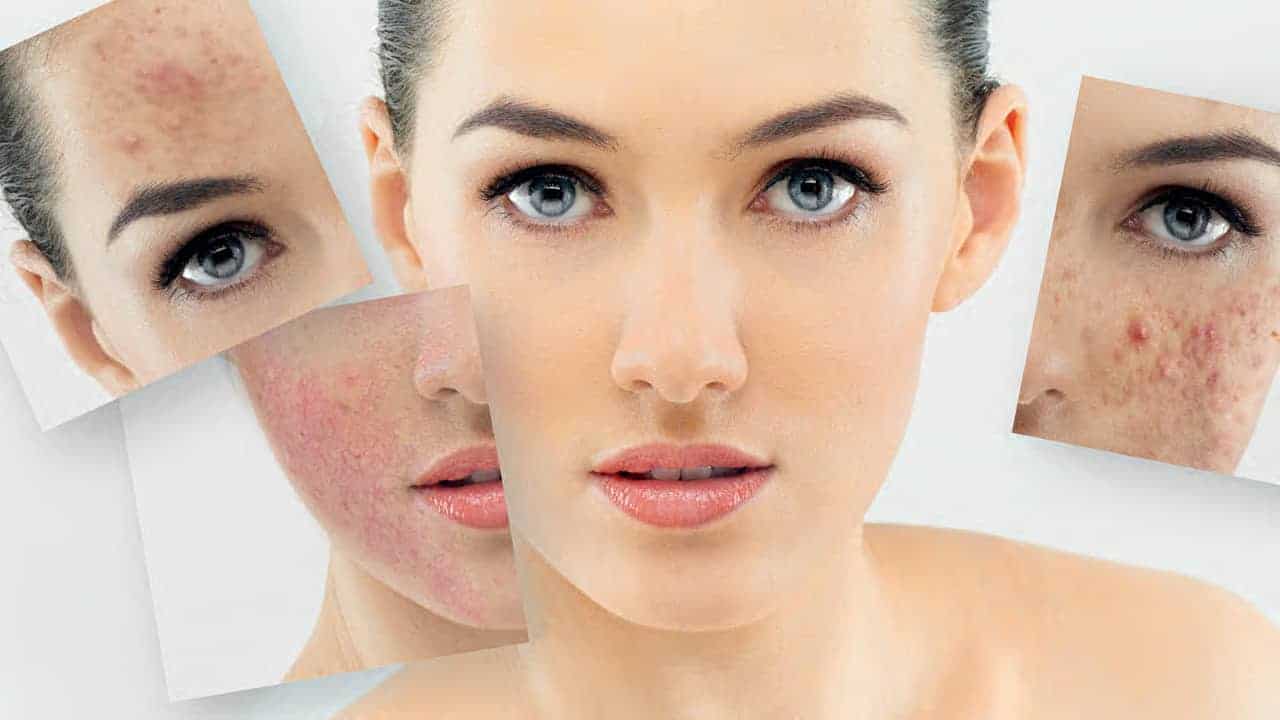 Rosacea und Demodex
